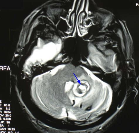 mri test for vertigo